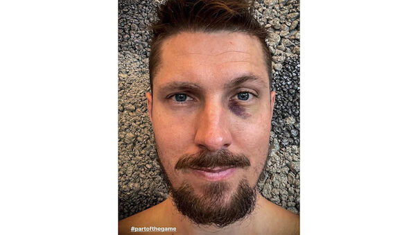 Marcel Hirscher holt sich blaues Auge