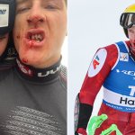 Freundin zeigt Bild von Haasers ausgeschlagenen Zähnen