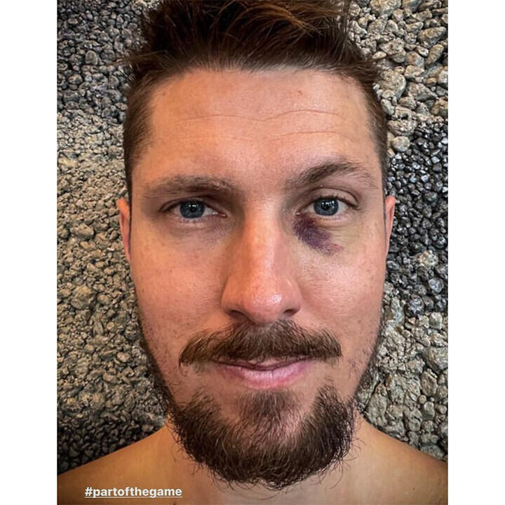 Marcel Hirscher holt sich blaues Auge